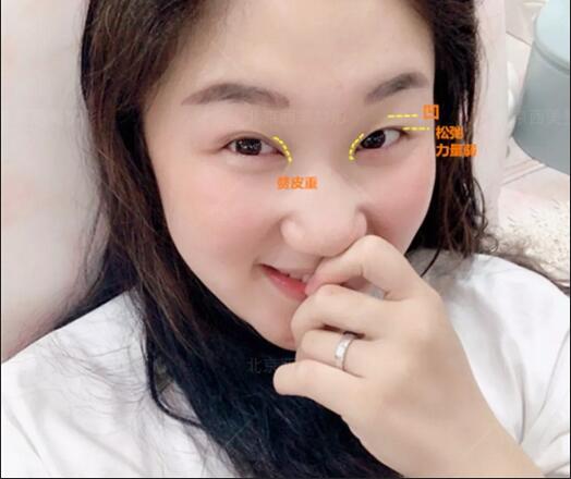 北京西美医院靠谱吗？来看看刘野院长做的双眼皮案例哇！