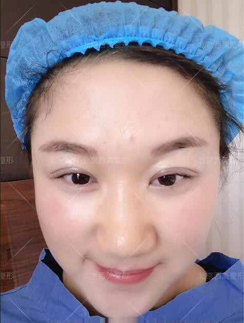 北京西美医院靠谱吗？来看看刘野院长做的双眼皮案例哇！