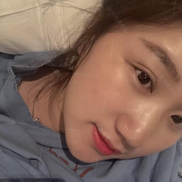 北京西美医院靠谱吗？来看看刘野院长做的双眼皮案例哇！