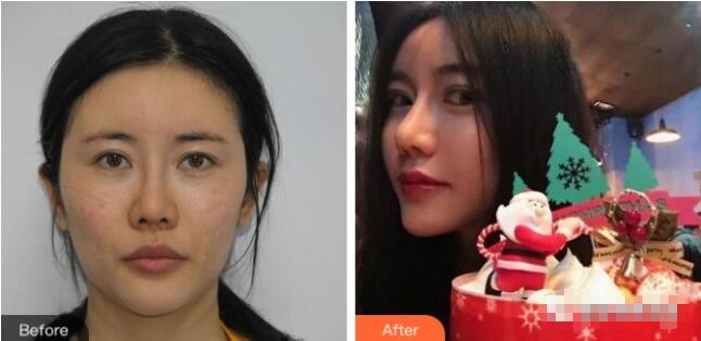 邯郸京美整形怎么样?附面部年轻化真实案例!