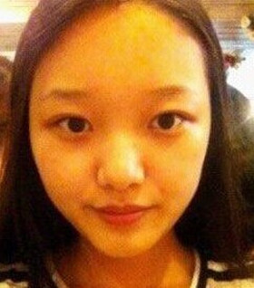 济南旭美整形怎么样?王彪医生鼻部整形案例流出~