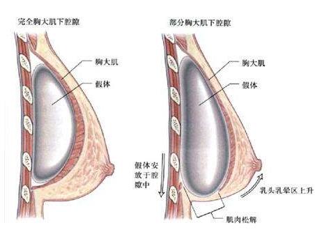 蜜桃假体隆胸的危害有哪些?优点又有那些呢?