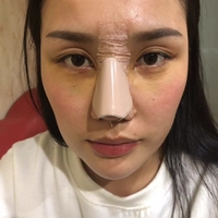 上海宏康整形医院怎么样?隆鼻真实案例分享~