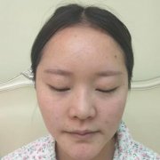 西安致美医院【价目表】内附垫鼻梁前后对比图 width=
