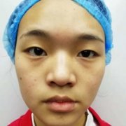 盛宗顺医生做双眼皮怎么样?真人案例展示~ width=