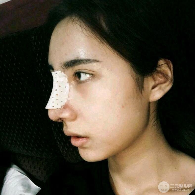 周栩医生技术如何?隆鼻案例及果图分享~