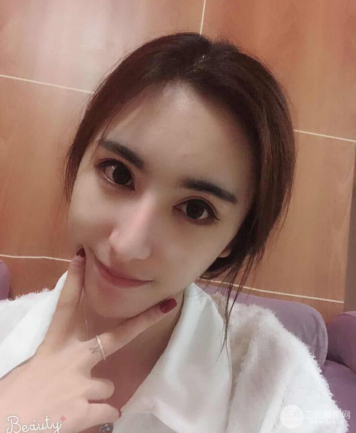 周栩医生技术如何?隆鼻案例及果图分享~