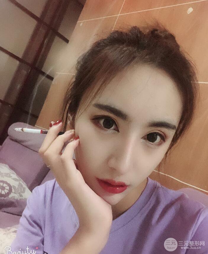 周栩医生技术如何?隆鼻案例及果图分享~