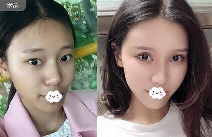肖蓉医生技术如何?隆鼻案例分享~