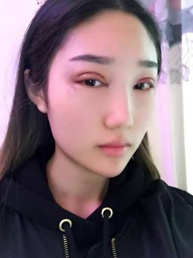 韩式微创双眼皮案例分享，还有恢复期图片哟~