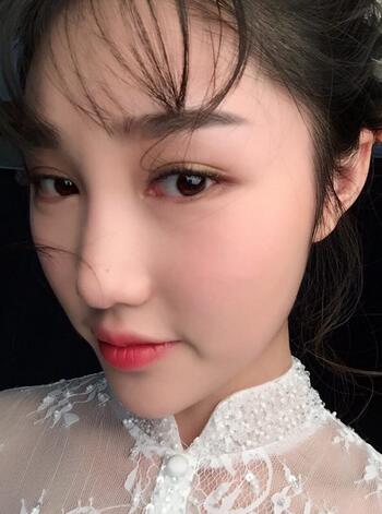 韩式微创双眼皮案例分享，还有恢复期图片哟~