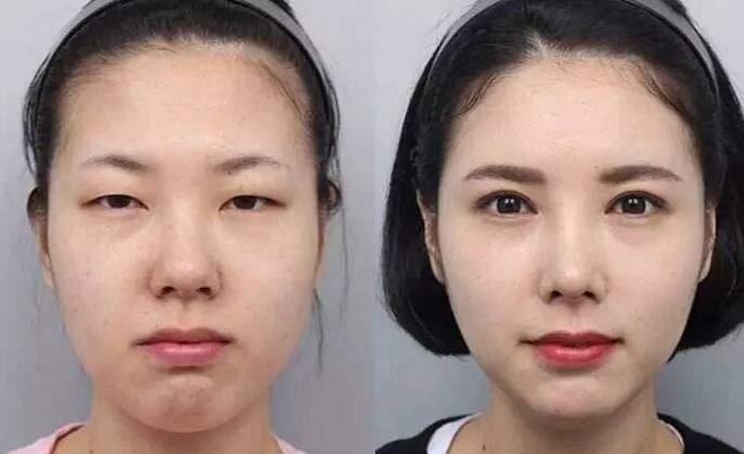 周钧医生技术如何?眼部案例及果图分享~