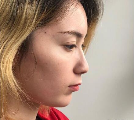 上海罗澜涛医生技术怎么样?做鼻子果如何?