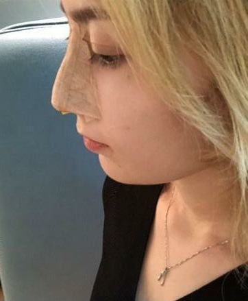 上海罗澜涛医生技术怎么样?做鼻子果如何?