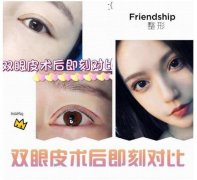 上海star極致美怎么样?双眼皮+开眼角真实案例分享~ width=