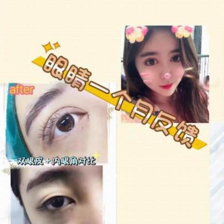 上海star極致美怎么样?双眼皮+开眼角真实案例分享~