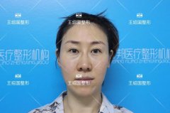 【王绍国院长面部加减法案例】——一名实力派的整形医生并不容易~ width=