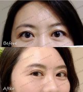 隐形眉眼提升，到底是什么一键扩大双眼神器？ width=