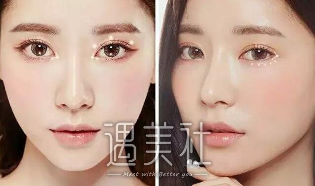 芜湖朱唯力双眼皮案例及果图分享，惊掉了我的下巴!