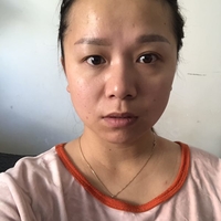 芜湖朱唯力双眼皮案例及果图分享，惊掉了我的下巴!