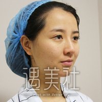 王英俊医生技术如何?自体活细胞脂肪填充案例分享~