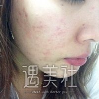 深圳市春天医院怎么样?祛痘真实案例分享~