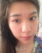 自体软骨隆鼻真人案例，图片分享恢复过程~ width=