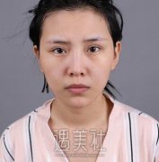 祁左良医生案例——双眼皮修复的神奇操作 width=