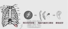 章庆国耳再造案例：他真的改变了我人生命运 width=