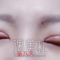 北京玲珑梵宫刘军技术如何?全切双眼皮的技术能过关吗?