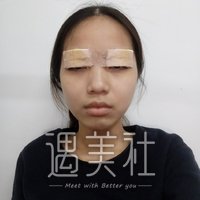 全切双眼皮大小眼调整案例分享~我终于有了出头之日!