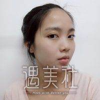 全切双眼皮大小眼调整案例分享~我终于有了出头之日!