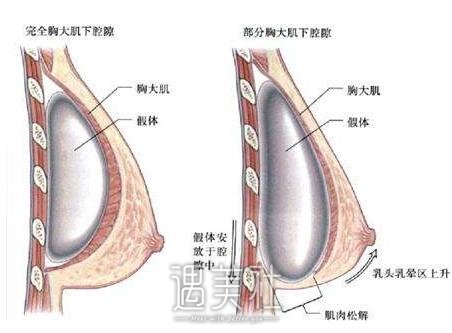 妙桃琴面假体会烂吗?质量是否值得信赖?