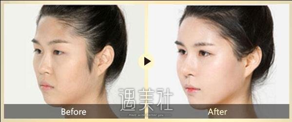 黑脸娃娃改良色素沉著做几次才会有显著果呢?