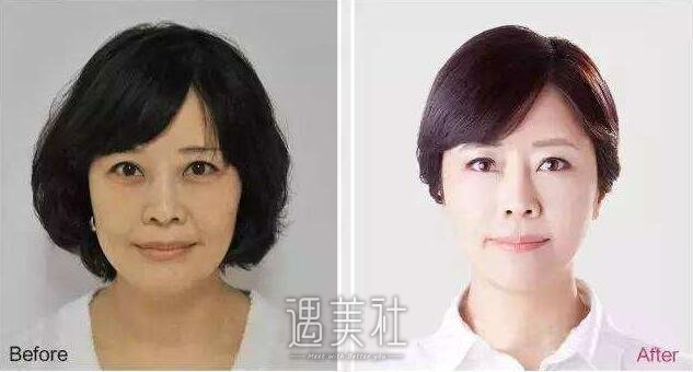 成都点阵激光一次有果吗?还能重返十八岁吗?