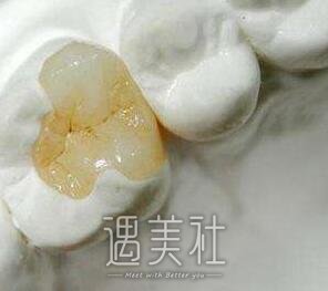 光固化树脂补牙寿命有多长，10年还是一辈子?
