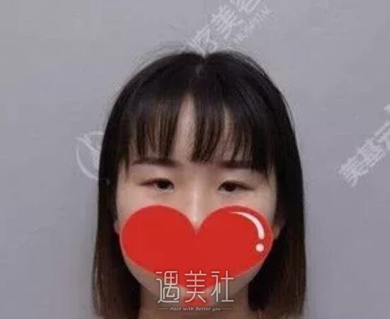 项利姣双眼皮案例展示，项利娇医生的技术真不错!