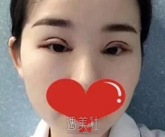 项利姣双眼皮案例展示，项利娇医生的技术真不错!