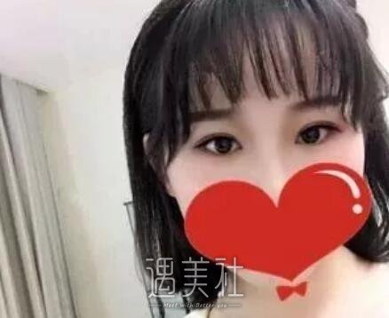 项利姣双眼皮案例展示，项利娇医生的技术真不错!