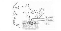 去颊脂垫恢复时间是短还是长，这真的是个问题~ width=