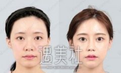 颧骨内推术后要注意什么??敲黑板了! width=