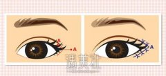 开外眼角能做到多大才适合? width=