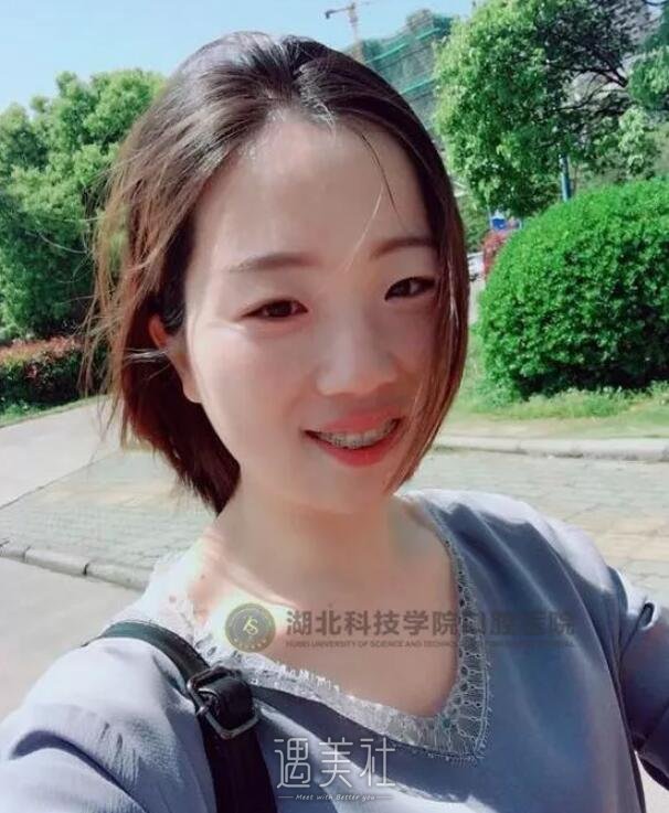 正畸凸嘴矫正案例分享，亲身讲述我的变化史!