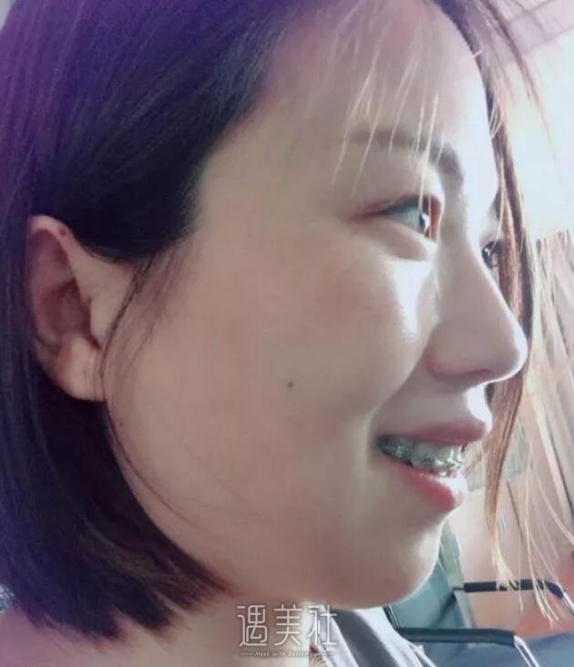 正畸凸嘴矫正案例分享，亲身讲述我的变化史!