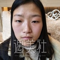 芜湖朱唯力双眼皮案例分享，一双眼就此改变一个人!