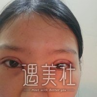 芜湖朱唯力双眼皮案例分享，一双眼就此改变一个人!