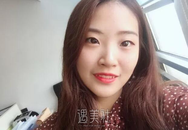 樊辉华双眼皮案例分享，亲身讲述手术及恢复全过程!