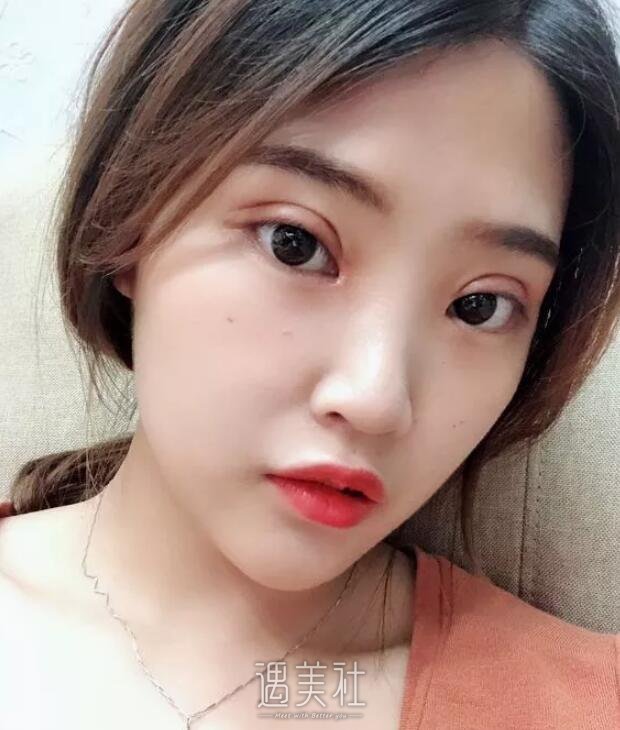 樊辉华双眼皮案例分享，亲身讲述手术及恢复全过程!