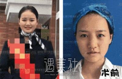 周珃小翘鼻案例展示，看她是如何逆天的!