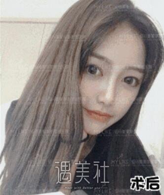 周珃小翘鼻案例展示，看她是如何逆天的!